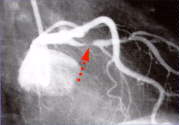 Occluded LAD Coronary Artery